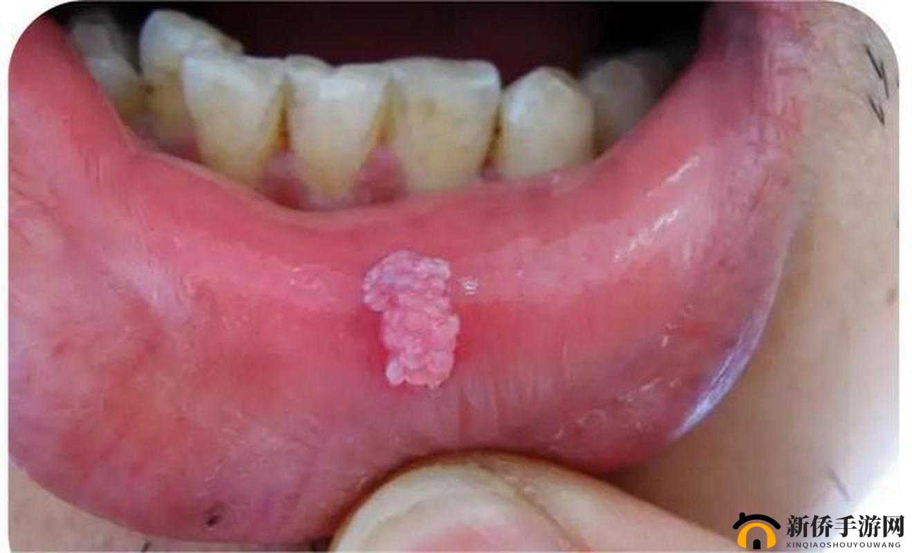 女的用嘴巴吃鸡会得 HPV 即将上市