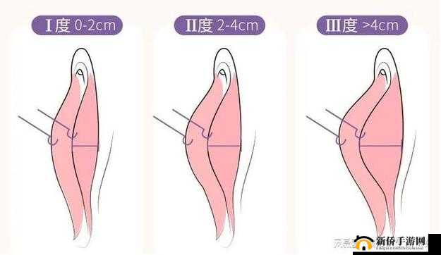 小阴天唇肥大整形有必要吗:是跟风还是科学抉择?