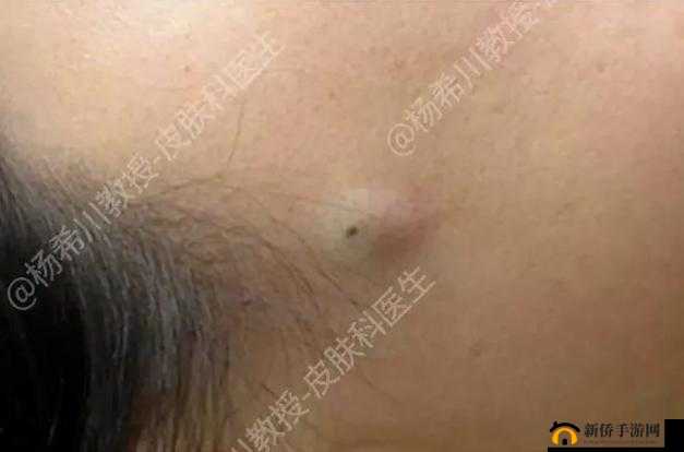 女性三角毛毛区长了个硬疙瘩可能是什么原因引起的该如何处理
