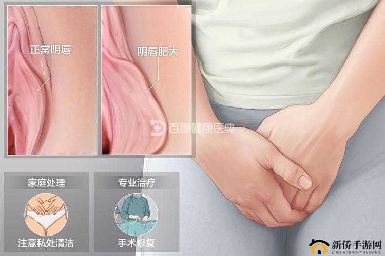 阴脣肥大的图示蝴蝶:独特之美引人深思